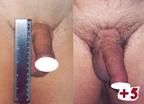 resultados antes e depois de aumentar o membro