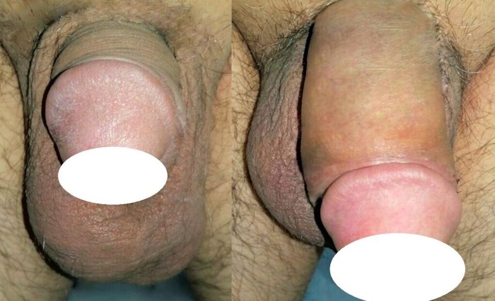fotos antes e depois do aumento do pênis